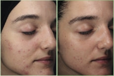 BEFORE-AFTER-BLEMIDERM-2.jpg__PID:4308900b-8e2f-4c17-a37a-709369f55187