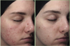 BEFORE-AFTER-BLEMIDERM-3.jpg__PID:08900b8e-2fdc-47a3-ba70-9369f551870b