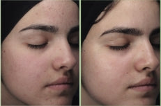 BEFORE-AFTER-BLEMIDERM-4.jpg__PID:900b8e2f-dc17-437a-b093-69f551870b20