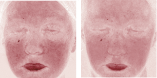 before-rosacea-1.png__PID:a425472d-6578-4293-93a1-349f79afe571