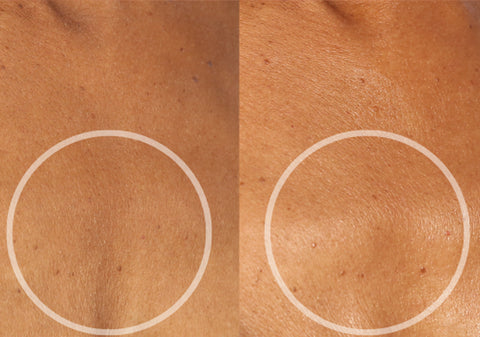 chest before and after using silicone wrinkle patches