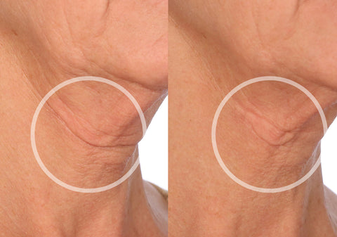 neck before and after using silicone wrinkle patches