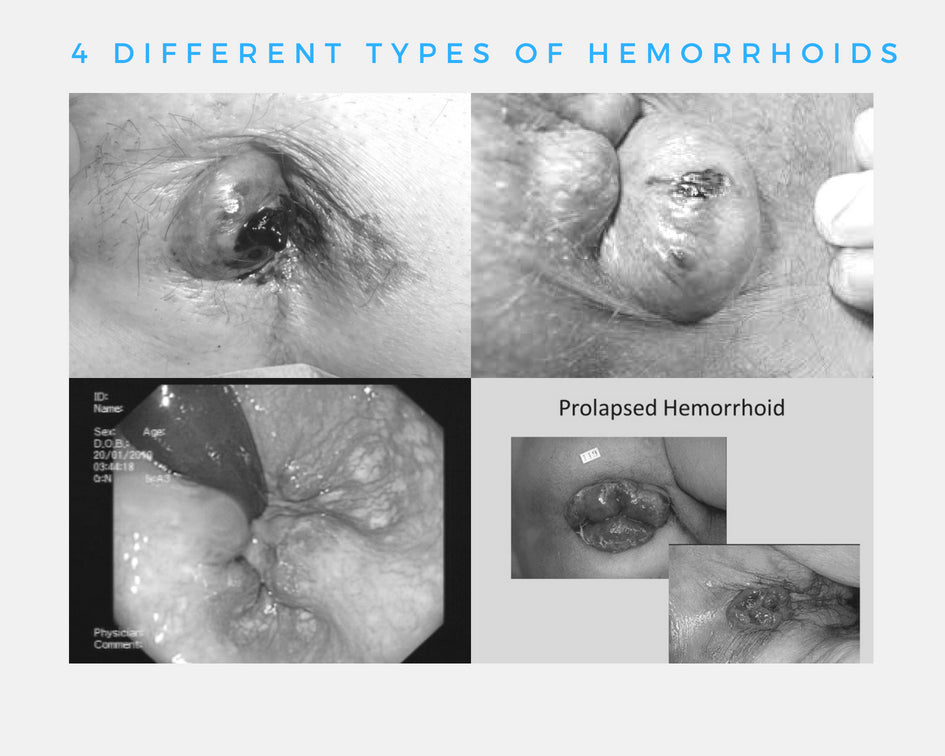 The 4 Different Types of Hemorrhoids and What You Must ...