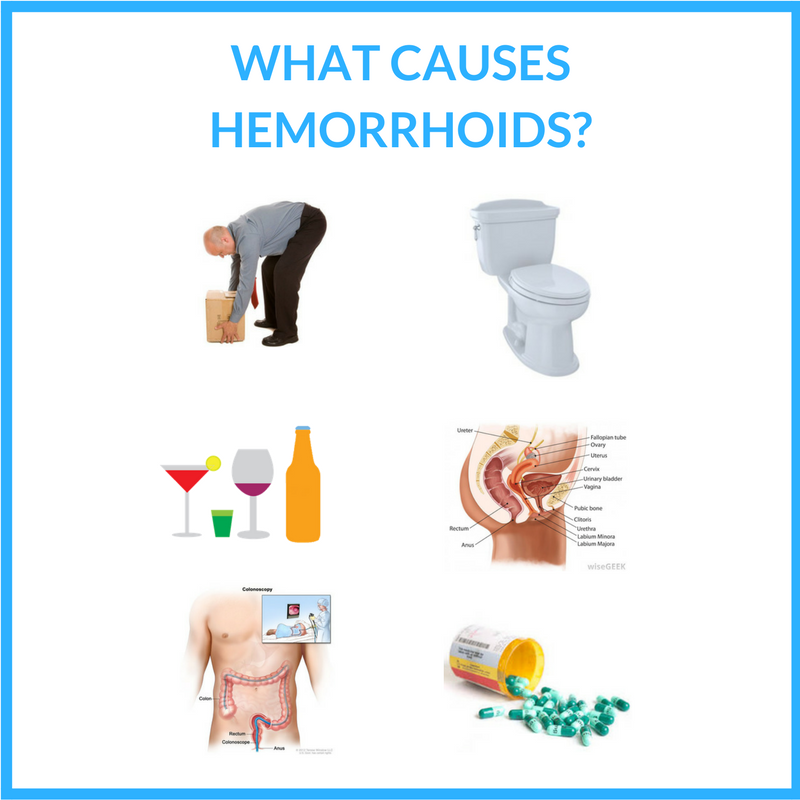 Hemorrhoid Causes Guide 101 Discover What Causes Hemorrhoids And How You Can Stop Them 0781