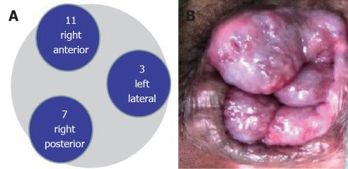 common position of internal hemorrhoids