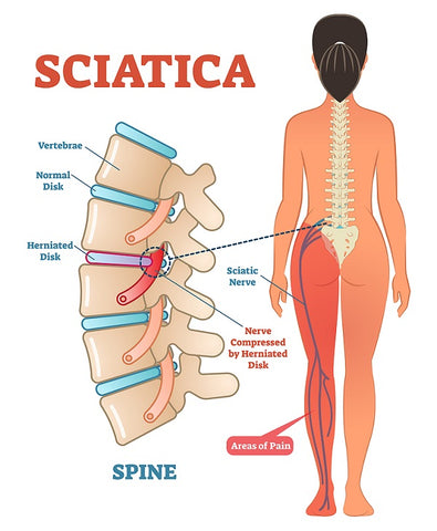 Will sleeping directly on the floor improve your sciatica