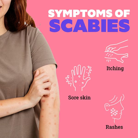 Natural Treatment for Scabies