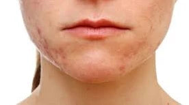 acne on chin