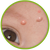 Natural Treatment Options for Molluscum Contagiosum Natural Treatment Options for Molluscum Contagiosum