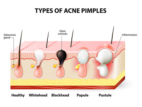 naturasil types of acne