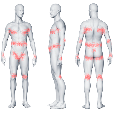 scabies locations