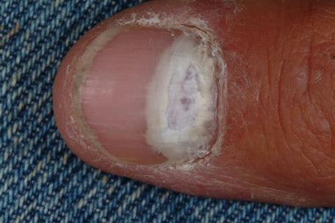 Toe Fungus