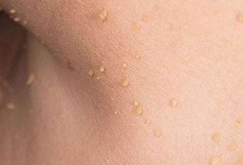 cancerous skin tags pictures