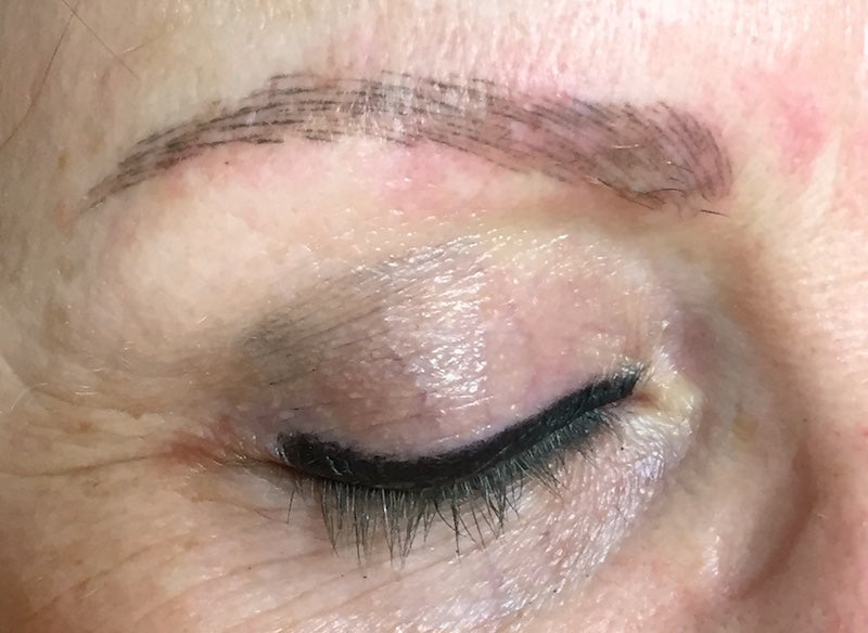 Uneven Deposit after Microblading Procedure due to Poor Stretching