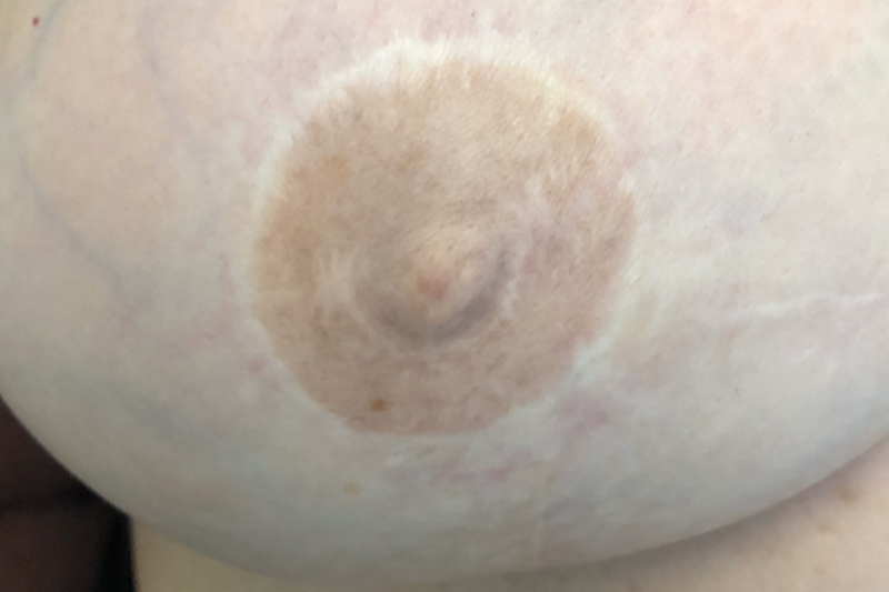 Areola Tattoo Before by Jill Hoyer