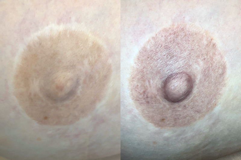 Areola Tattoo Before and After Results by Jill Hoyer