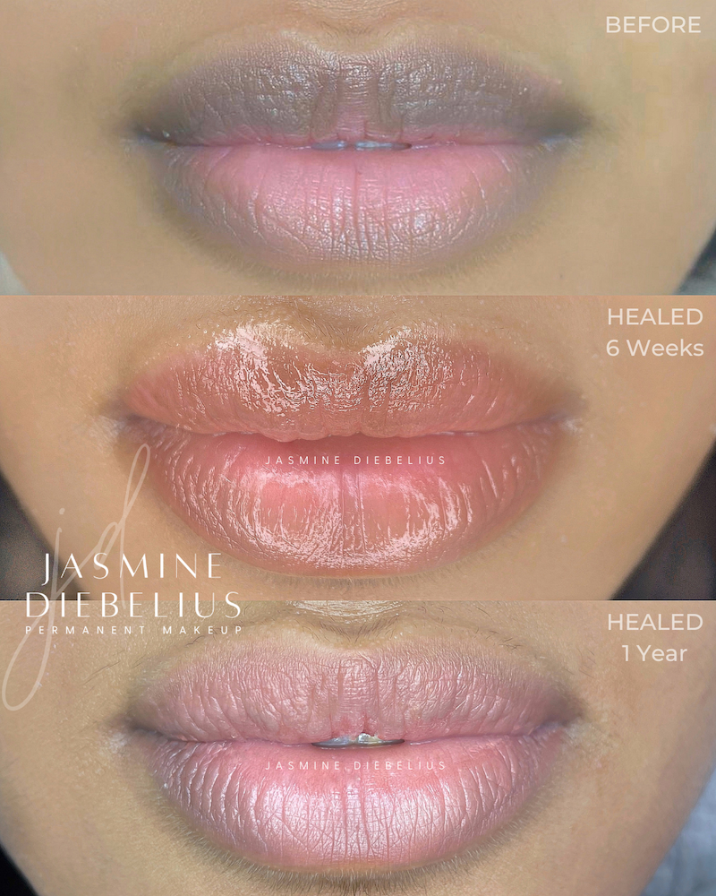 Before After and Healed 1 year Lip Neutralization Procedure Results by Jasmine Diebelius