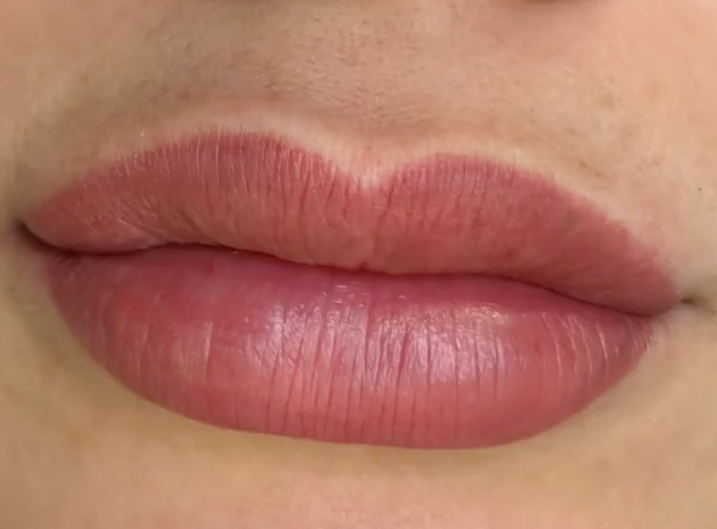 Healed Fitzpatrick 4 Lips Case Study