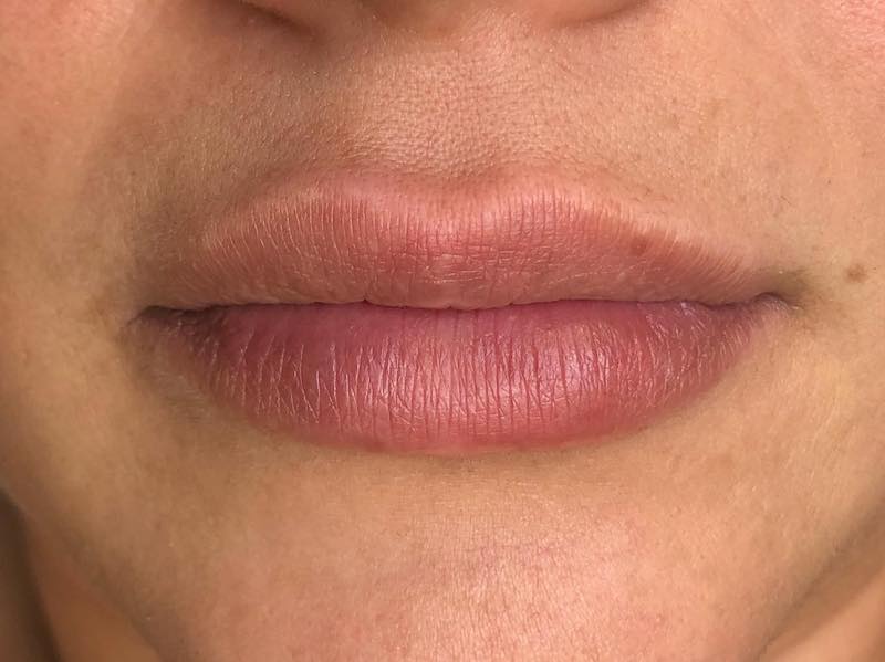 Case Study: Fitzpatrick 4 Healed Lips Before Client Photo