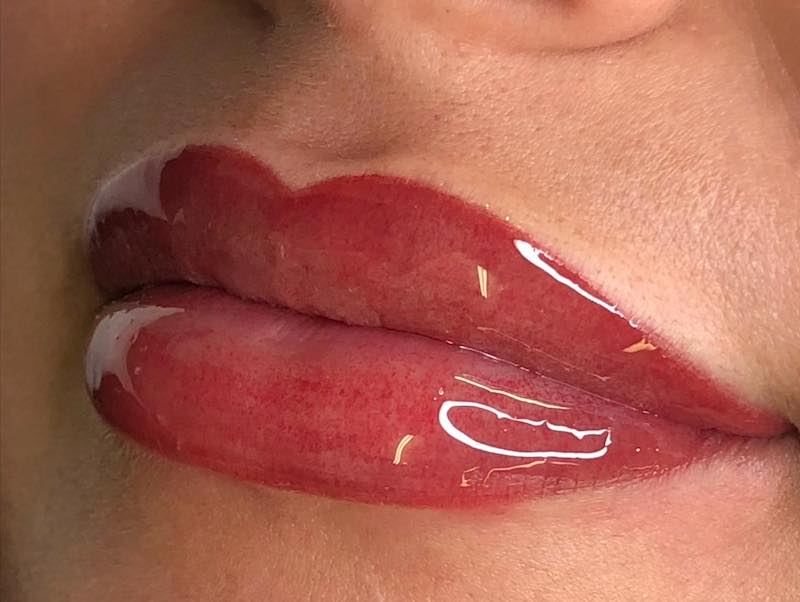 Healed Fitzpatrick 4 Lips Case Study