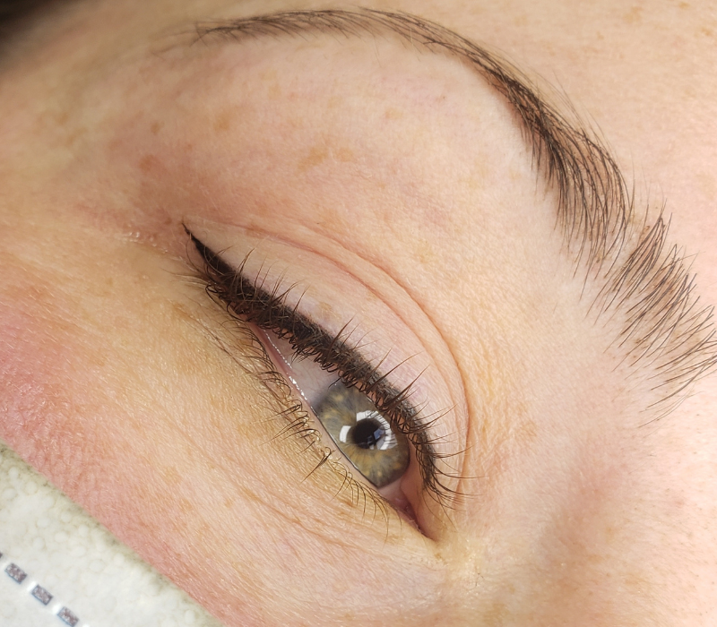 Permanent Makeup Removal Before After Picture