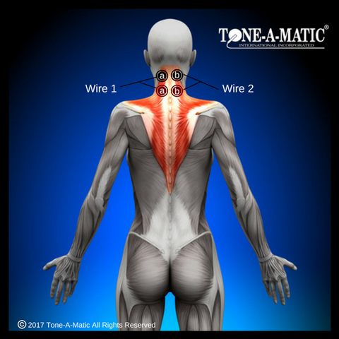 tens electrode pad placement chart for neck pain