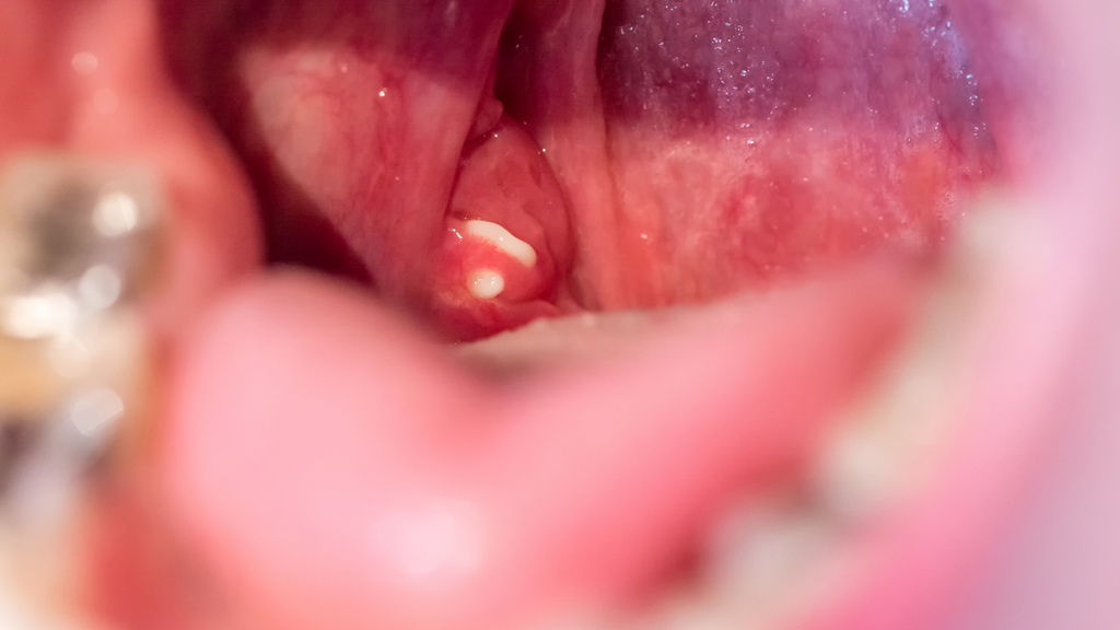 What tonsil stones look like