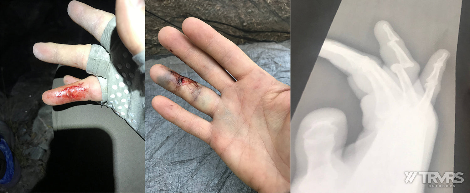 Cameron Hummel's Broken Finger - Pfiffner Traverse, Rocky Mountains, Arapaho, Indian Peaks, Colorado, Ultralight, Backpacking | TRVRS Outdoors