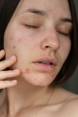 Acne and blemish prone skin blog One Fine Secret
