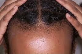 A person of color showing their scalp. 