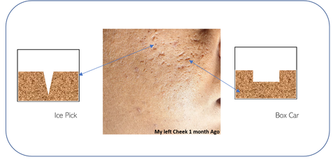 illustration of ice pick scarring and boxcar scarring