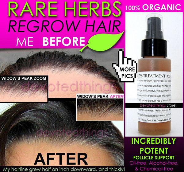 7 Before and After Organic Hair Growth Fast Hair Regrowth ...