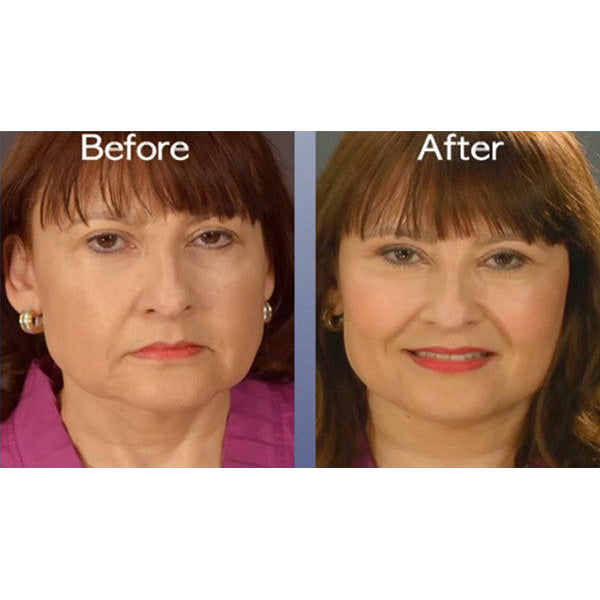 FREE Plastic Surgery: Face Lift Tape Tutorial