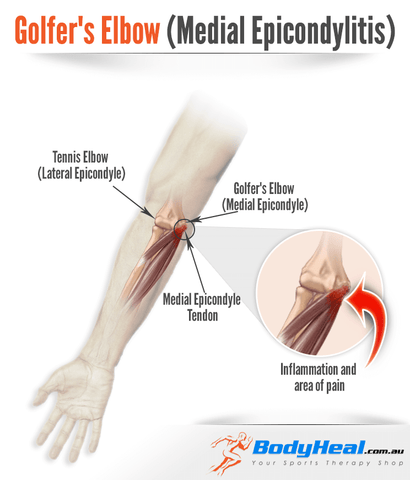 Golfer's Elbow Diagram