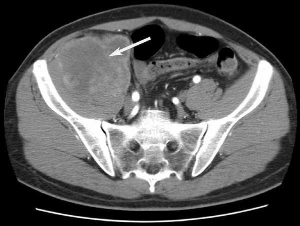 pre operative pelvic tumour the size of a football located on patient