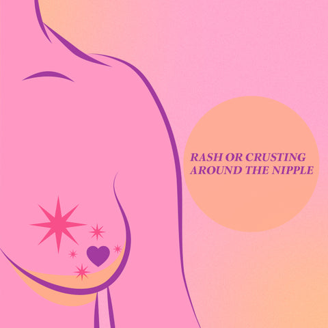 breast cancer signs, rash or crusting around nipple