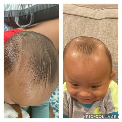 Infant hair loss  BabyCenter