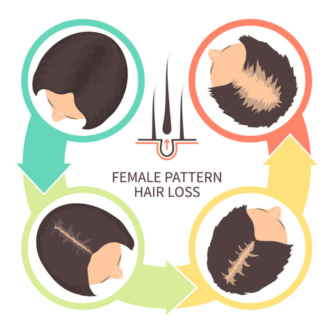 female pattern hair loss