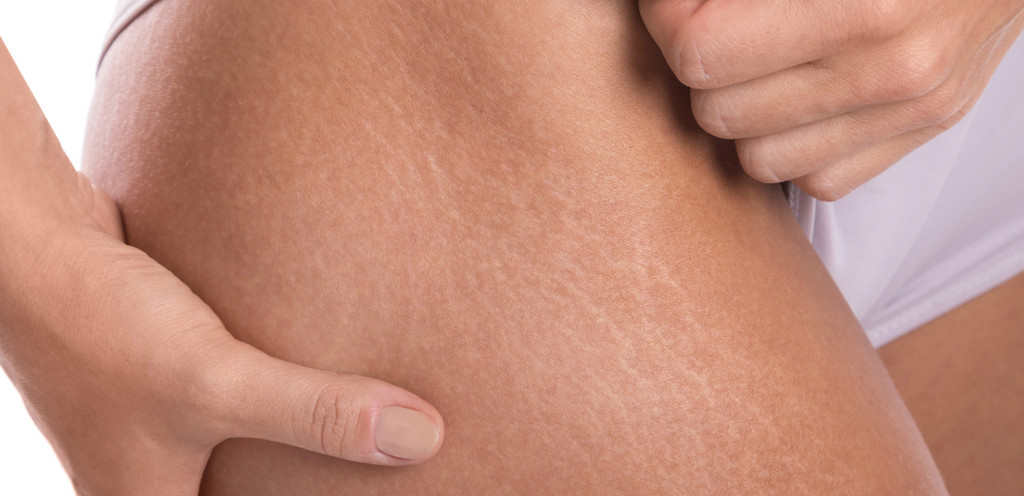 How to get rid of stretch marks Evolve Organic Beauty
