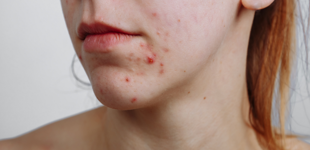 How to get rid of pregnancy acne Evolve Organic Beauty