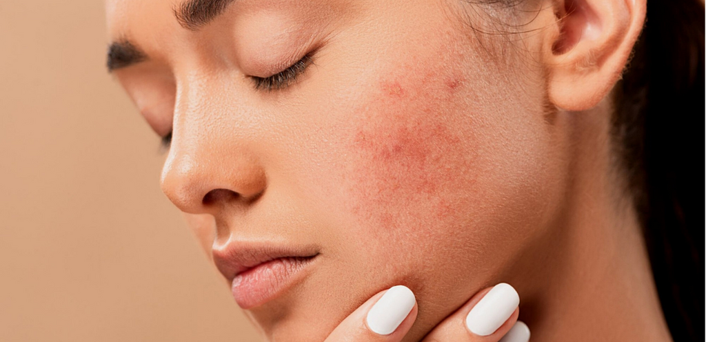 Can lack of sleep cause acne? Evolve Organic Beauty