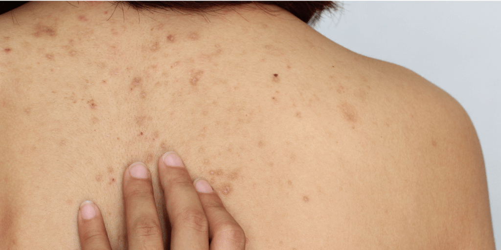 How to get rid of bacne and back spots 