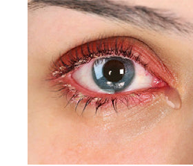 Dry and irritated eyes, EVOTEARS Omega eye drops