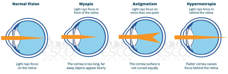 Optics for lasik, Lasik eye procedure, what is nearsightedness, types of eye problems