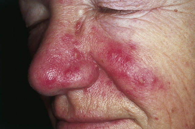 man with rosacea