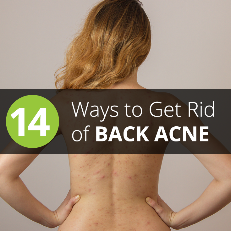 14 Ways Get Rid Bacne