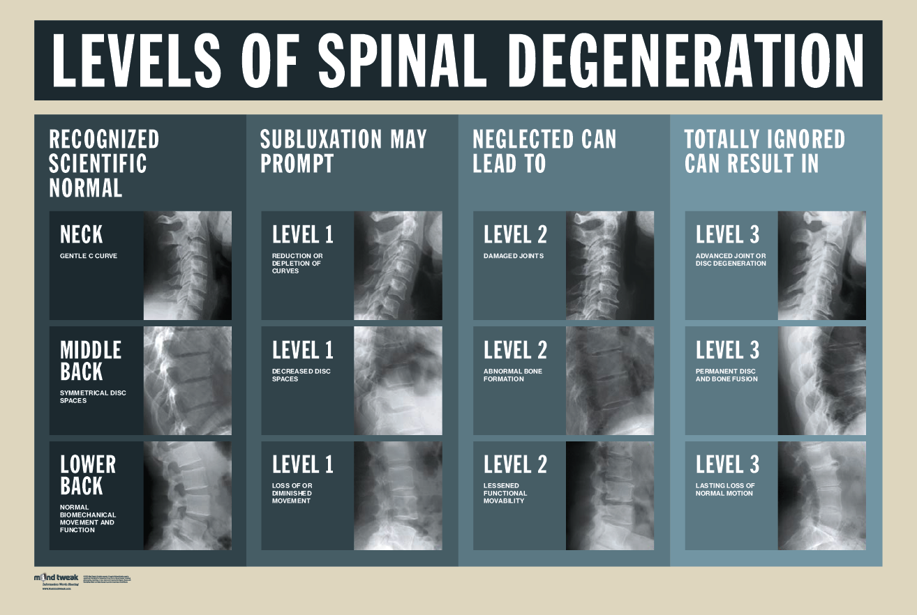 Levels Of Spinal Degeneration MIND TWEAK   Unspecified 2 17ca203c 37a3 443d 8637 087df4f4be01 