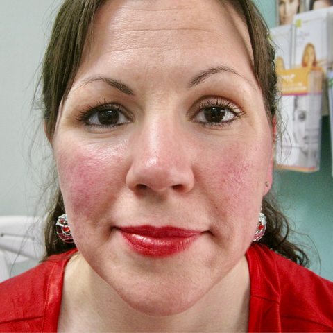 best natural skin care rosacea