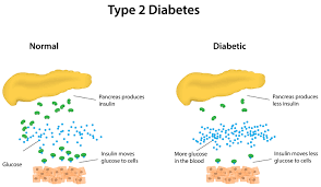 Diabetes tipo 2