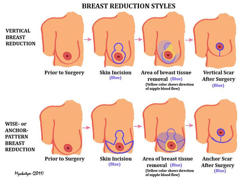 Breastfeeding After Breast Augmentation - Ardo: Supporting Pregnancy,  Birth, & Breastfeeding